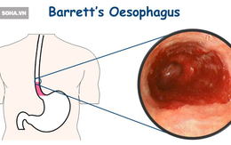 Bác sĩ khuyên bạn tránh 3 tác nhân gây bệnh ung thư thực quản
