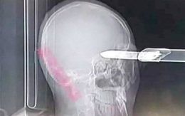Bị dao găm vào đầu, người đàn ông sống sót kỳ diệu
