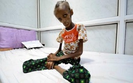 Thiếu nữ 18 tuổi gầy trơ xương vì đói ăn ở Yemen