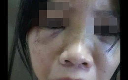 Nữ sinh run sợ kể phút bị bạn châm thuốc lá vào tay, bắt liếm chân