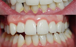 Dành 3 phút buổi tối làm việc này thì cả đời không cần đi nha sĩ lấy cao răng