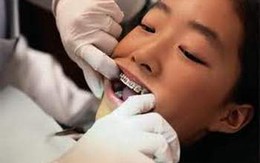 Bí quyết vệ sinh răng miệng khi nắn chỉnh răng