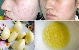 Ám ảnh "da mụn" sẽ không còn chỉ với nguyên liệu 2 ngàn đồng có sẵn trong bếp