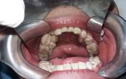 Hoảng hồn với chàng trai có hàm răng thừa gần… 20 chiếc