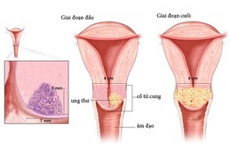 4 bước phát hiện sớm ung thư cổ tử cung