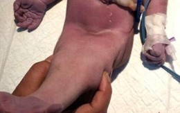 Em bé “người cá” chào đời ở Ấn Độ