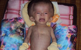 Bé gái 3 tháng tuổi đầu to hơn người sự sống dần lụi tắt vì không tiền chữa bệnh