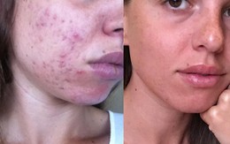 Cô nàng này đã hết hẳn mụn khi áp dụng công thức chăm sóc da 100% thiên nhiên