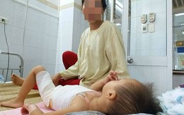 Bé gái 23 tháng tuổi bị bỏng nặng vì bà pha mỳ tôm để cạnh mép bàn