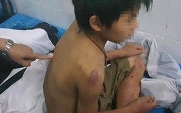 Cậu bé 11 tuổi nghi bị bố đánh đa chấn thương