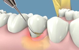 Cách hạn chế cao răng