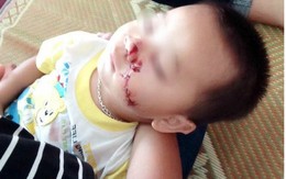 Bố say rượu, con 2 tuổi bị dao cứa rách mặt