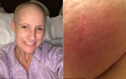 Chỉ bị phát ban trên da, bà mẹ 2 con sốc nặng khi được chẩn đoán mắc bệnh ung thư