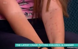 Bé gái 12 tuổi làm bỏng chi chít cánh tay để đua theo trào lưu