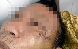 Kinh hoàng bố bị con trai đánh bầm dập, gãy xương sườn, mẻ bánh chè