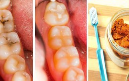 Thấy răng chớm có chấm sâu, đắp liền thứ này vào sẽ khỏi ngay