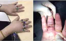 Đeo nhẫn đủ 10 ngón tay, người phụ nữ thích khoe của khóc tu tu gọi đội cứu hộ vì không tháo ra được