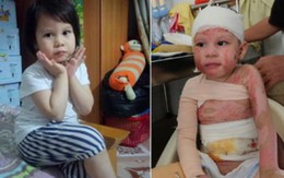 Hành trình hồi phục kỳ diệu của bé gái 5 tuổi bị bỏng cồn do nhân viên nhà hàng sơ ý
