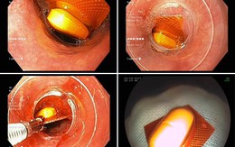 Bi hài những ca nội soi lấy dị vật ở người lớn