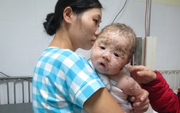 Nhìn bé trai 4 tháng tuổi đau đớn vì thủy đậu biến chứng, ai cũng xót xa