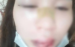 Đồng Nai: Giúp người bị thương, thiếu nữ bị đánh lệch sống mũi