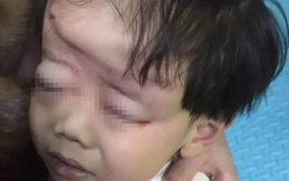Mẹ mải xem điện thoại, con 4 tuổi bị xe cán biến dạng đầu