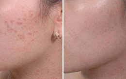 Quy trình chuẩn trị mụn ẩn dưới da tại nhà siêu hiệu quả
