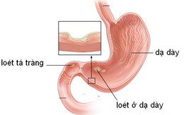 Nguyên nhân loét dạ dày - tá tràng