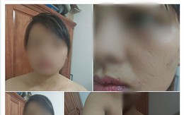 Hà Nội: Từ chối nộp hết tiền kiếm được hàng tháng cho mẹ chồng, người phụ nữ bị nhà chồng đánh thâm tím khắp người