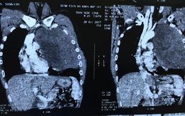 Ho khan 1 tháng, chàng trai 25 tuổi suýt nguy kịch vì khối u nặng 3kg ở ngực