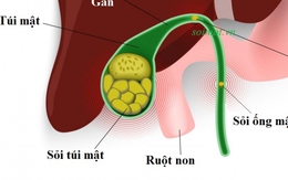 Phòng sỏi mật tái phát, cách nào?