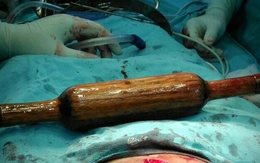 Chồng nhét cả chày cán bột vào bụng vợ vì vô sinh