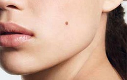 Dấu hiệu nhận biết nốt ruồi chuyển thành ung thư?