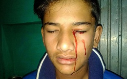 Cậu bé Ấn Độ khóc ra máu 10 lần một ngày