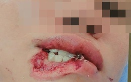 Cô ruột cắn cháu gái đứt lìa 1/3 môi