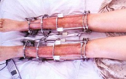Tiến trình đau đớn đầy rủi ro khi phẫu thuật kéo dài chân