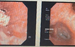 Miếng mề hột vịt lộn khiến cụ ông suýt chết