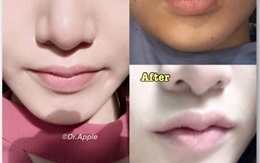 Bất chấp tai biến, nhiều chị em 'bạo tay' chi tiền để làm môi sừng trâu
