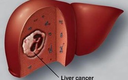 Chỉ mặt thói quen hàng đầu khiến ung thư gan ở Việt Nam tăng vọt quá nhiều người mắc