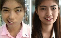 Nữ sinh Thái Lan biến dạng mặt vì bị thầy giáo ném cốc vào đầu