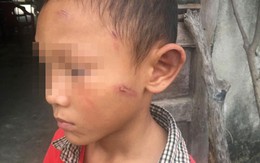 Bé trai 5 tuổi bị dì ruột bạo hành dã man