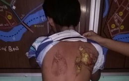 Cô bé 13 tuổi đi làm giúp việc bị chủ nhà dùng bàn là nóng bạo hành rồi đổ nước sôi lên người