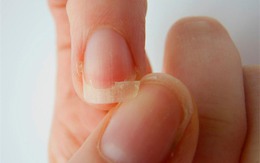 Móng tay dễ gãy: 6 nguyên nhân thường gặp và cách khắc phục nhanh chóng