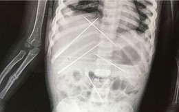 Bé gái 3 tuổi tử vong do bị ông chủ của mẹ đâm kim làm phép