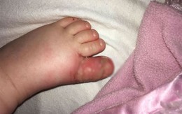 Bé gái phải cắt bỏ một ngón chân sau khi giẫm vào nước tiểu của chó