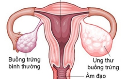 6 dấu hiệu cảnh báo bệnh ung thư buồng trứng, chị em cần lưu ý
