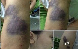 Bố đẻ nhẫn tâm hành hung con gái chấn động não