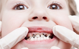 Dịch chiết sáp ong - Bước đột phá mới từ thiên nhiên giúp lợi chắc, răng bền