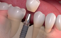 Tiết kiệm thời gian trồng răng Implant với ETK Active