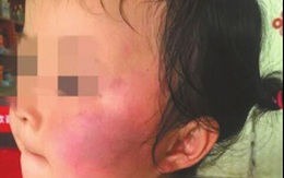 Không nghe lời, 2 bé mầm non bị cô giáo phạt tự tát nhau sưng mặt